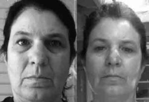 Before & After Photos - Facial Exercise | FlexEffect Facialbuilding