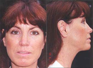 Before & After FlexEffect Facialbuilding